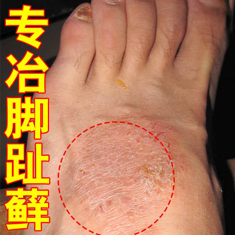 脚趾头长鲜痒去关节处长红斑疙瘩起硬皮裂口皮肤干裂溃烂脱屑掉皮
