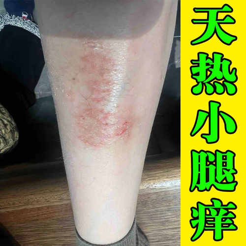 小腿痒起红疙瘩天热腿窝痒腿上起小红点疙瘩专用膏