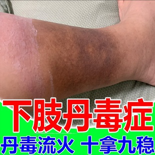 小腿丹毒皮肤红肿发热疼痛灼热流火皮肤下肢流火感染血泡外用