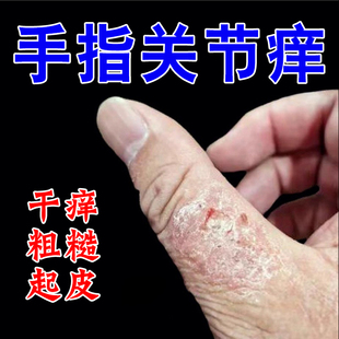 手指关节起皮真菌手指关节长硬疙瘩伤脱皮干裂口硬块软膏