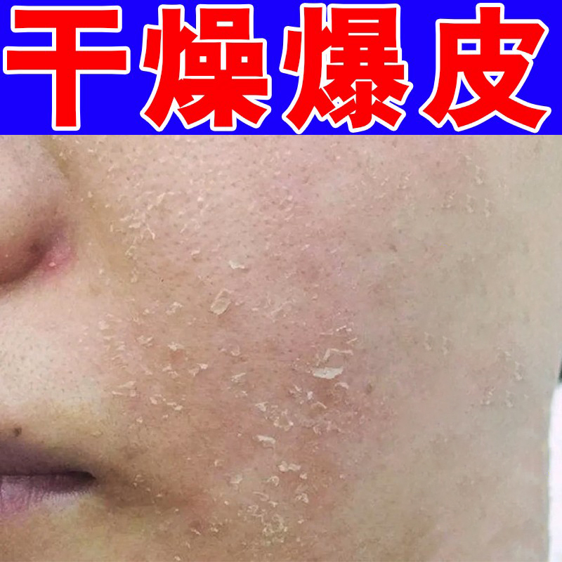 脸起皮干燥有碎屑修复男士T区干燥掉白皮痒换季爆皮疼痛滋润甘油
