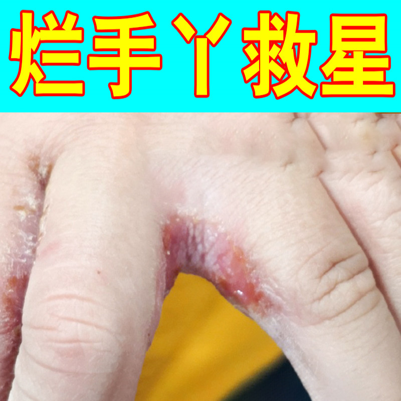手指缝溃烂烂手丫专药用指间红肿糜烂手气真菌感染手鲜软膏