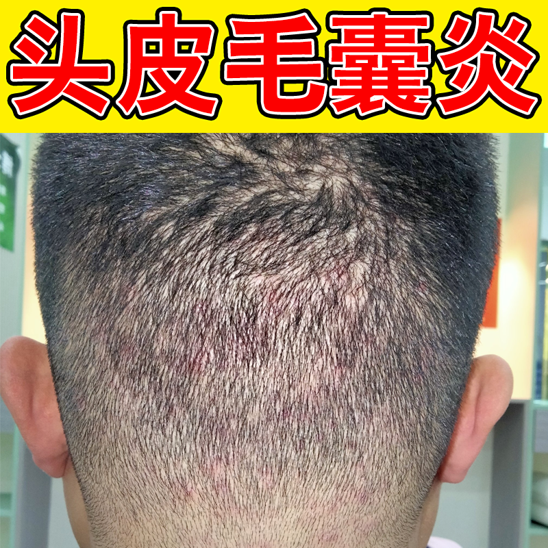 头上长豆豆头皮毛囊炎专用头皮长疙瘩浓包红肿干皮脂溢性感染软膏