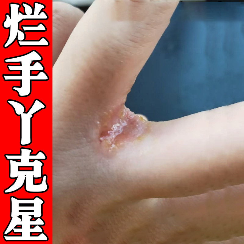 烂手丫专药用手指缝溃烂软膏手气脱皮杀菌手鲜膏真菌感染软膏