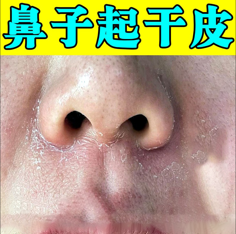 鼻子脂溢性皮炎两侧发红脱皮酒糟鼻翼两边泛红干燥起皮膏