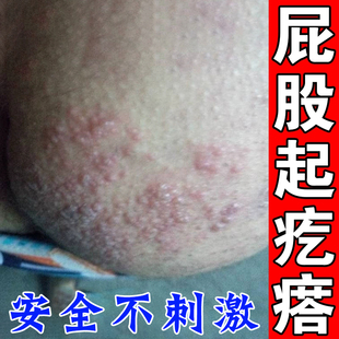 屁股长痘痘膏屁股上有疙瘩久坐屁股上长脓包痘痘皮肤过敏刺挠专用