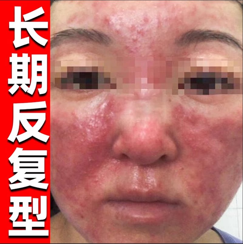 敏感脸部皮肤修复脸部泛红激素脸皮肤消毒护理（消）