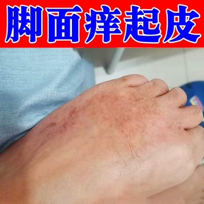 脚背脚面上干燥起皮起皮屑疙瘩皮肤刺挠