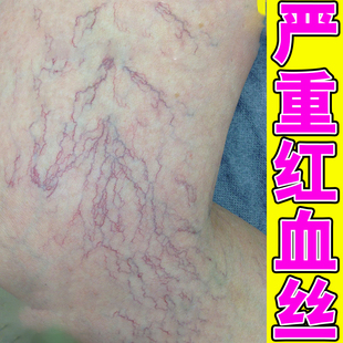 腿上有红血丝凝胶修复毛细血管扩张腿部青筋凸起软膏
