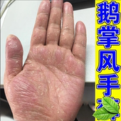 手上脱皮脚严重脱皮干裂膏手手起干皮专用软膏