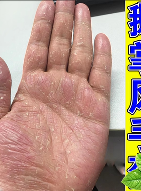 手上脱皮脚严重脱皮干裂膏手手起干皮专用软膏
