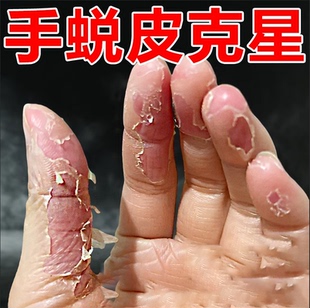 手脱皮严重脱皮季节性剥脱性角质松懈症手起皮干裂真菌膏