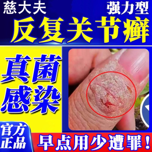 手指关节癣手癣脱皮干裂真菌感染湿疹手足硬皮止痒药监备案药膏LL