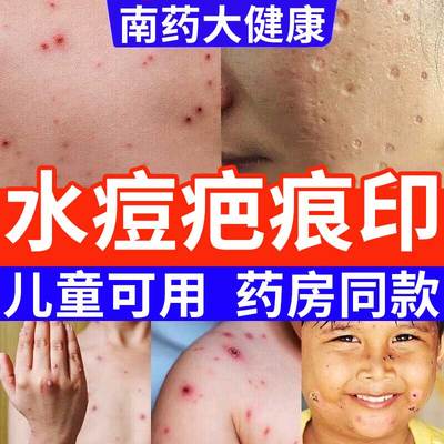 面部祛疤膏儿童专用小孩