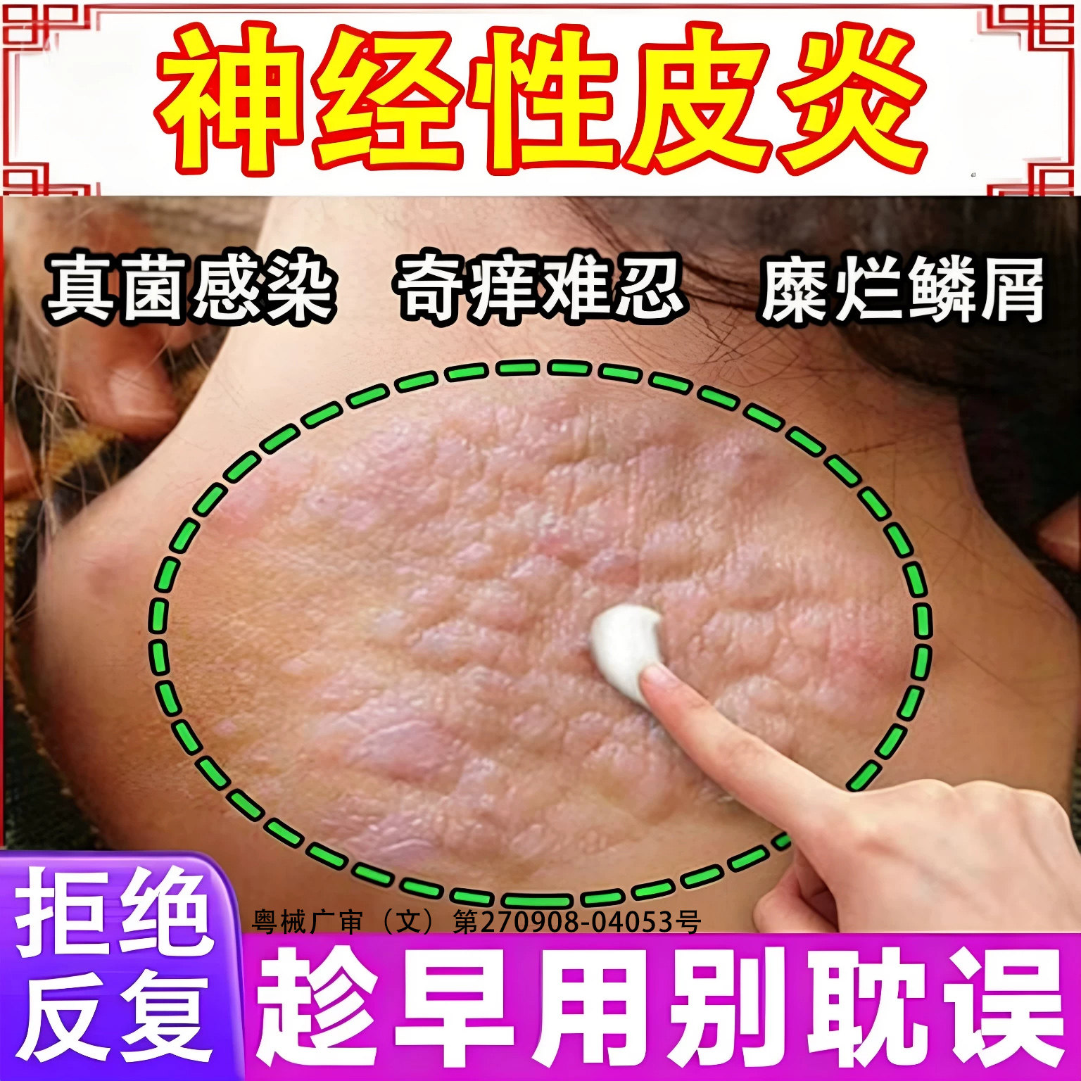 神经性皮炎特药效治疗顽固外用膏止痒肤病癣藓湿疹真菌感染瘙痒LT