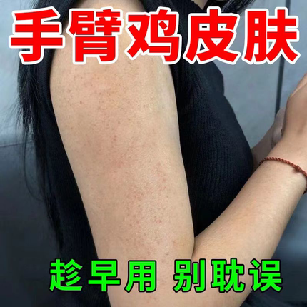 鸡皮肤疙瘩毛囊角化症专用膏周儿童手臂毛囊炎胳膊上长疙瘩去除UU