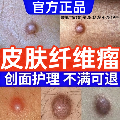 皮肤纤维瘤去除药膏硬块疙瘩结节脂肪瘤消瘤膏去皮赘软肉瘤肉粒PP