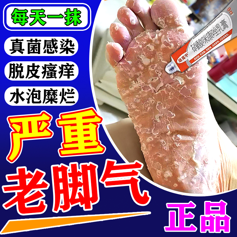 【达舒克】硝酸咪康唑乳膏20g*1支/盒