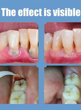 极速New 100g Quick Repasir of Cavities Caries Removal of Pla