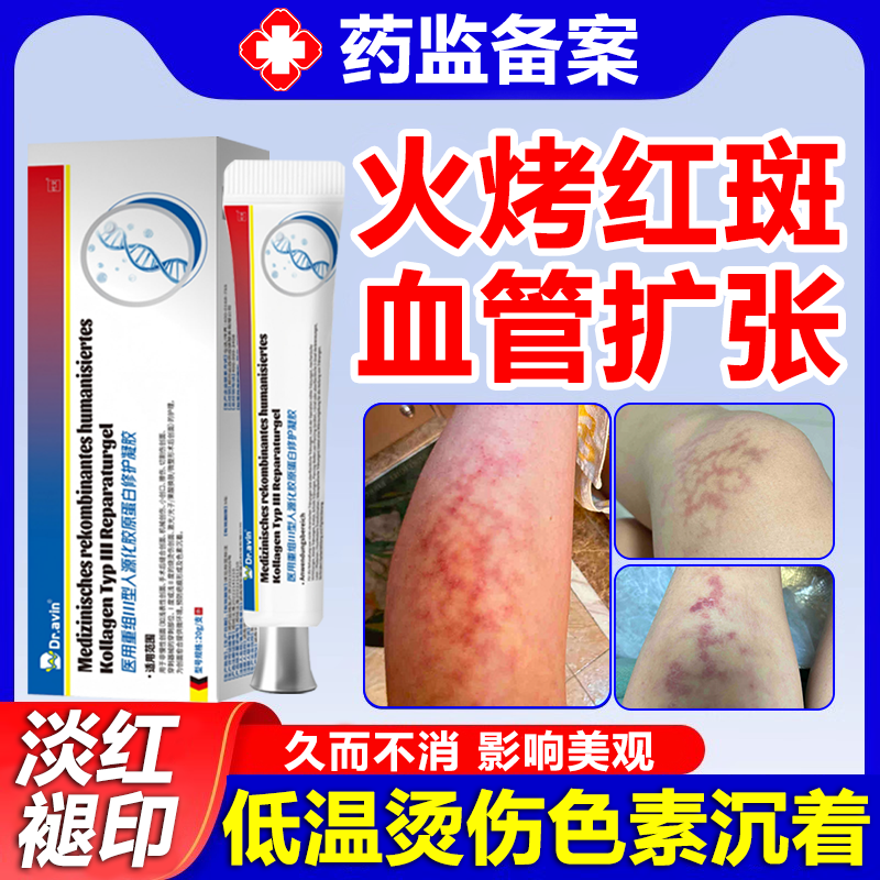 烤火激红斑低温烫伤去黑红印血丝色素沉淀毛细血管扩张增厚角质wg