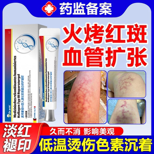 烤火激红斑低温烫伤去黑红印血丝色素沉淀毛细血管扩张增厚角质wg