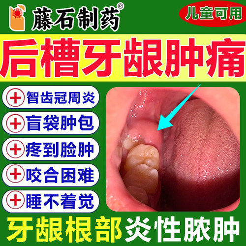 后槽牙龈智齿肉发肿疼痛消冠周炎
