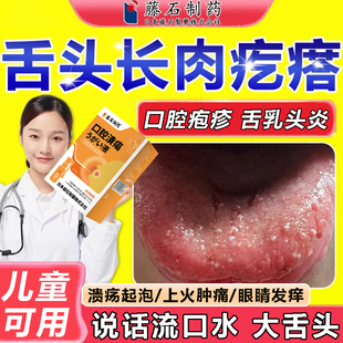 舌头上火长肉粒疙瘩舌乳头炎疱疹疼痛口腔舌根口舌生疮溃烂喷雾wg