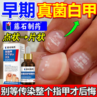 真菌性白甲空甲修复液感染灰手脚指甲发白变厚白边白线白斑白点xj