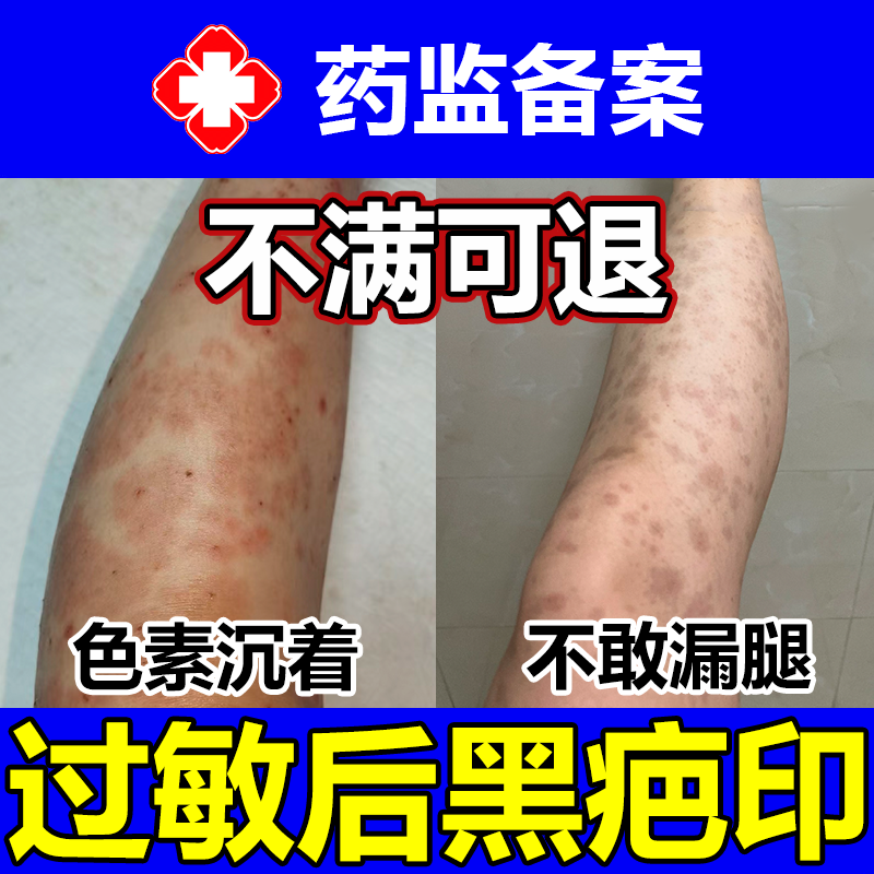 过敏留疤痕黑印色素沉淀药监备