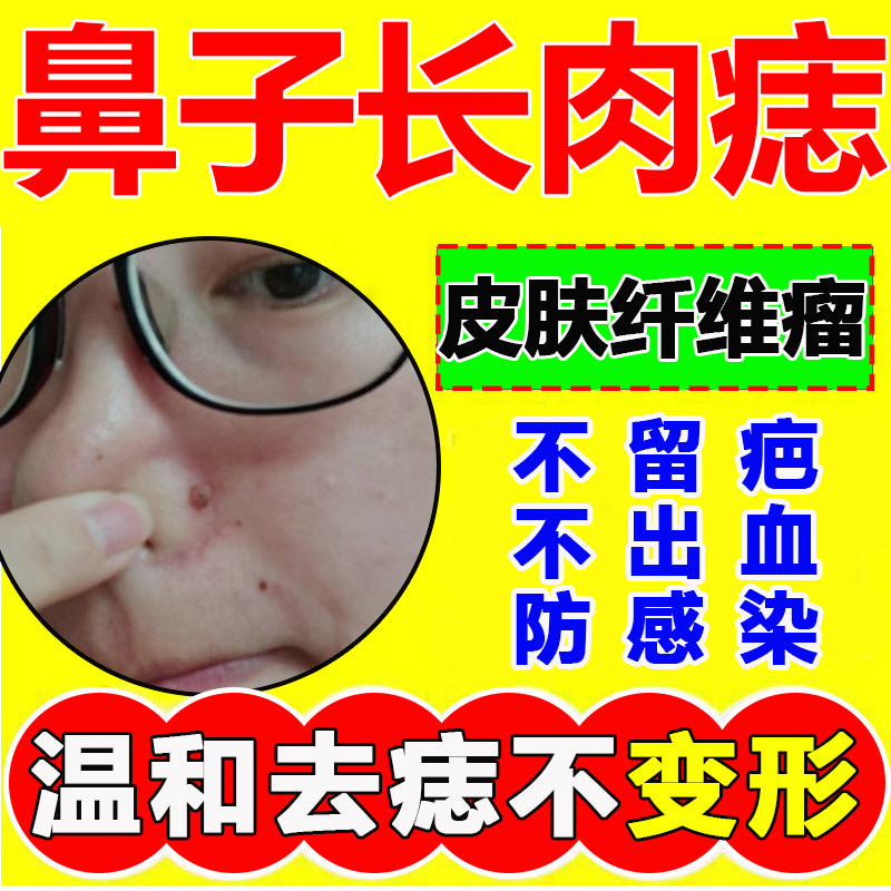 鼻子上长肉疙瘩皮肤纤维瘤肉痣小肉揪去痣除痣无痕灵药水神器yd