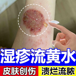 皮肤流黄水疮脓包疱疮湿疹止瘙痒苗草癣渗液结痂顽固皮炎药监备wg