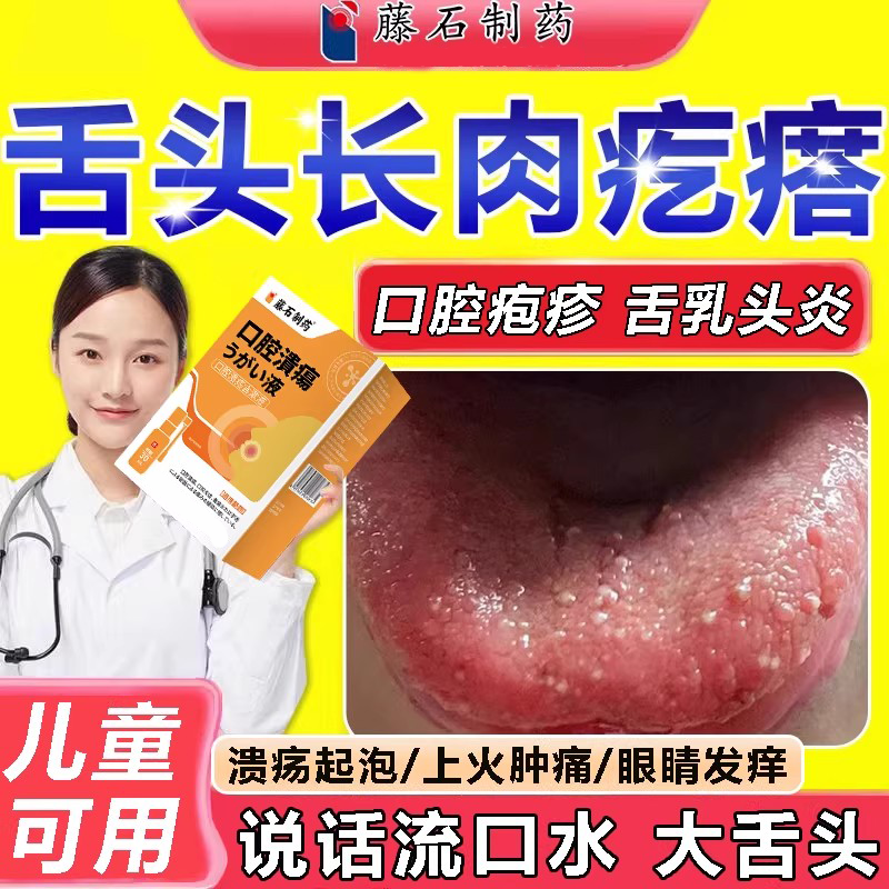 舌头上火长肉粒疙瘩舌乳头炎疱疹疼痛口腔舌根口舌生疮溃烂喷雾wg