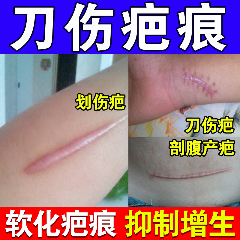 去刀疤修复除疤膏贴剖腹产疤痕增生凸起去除疙瘩手术祛疤旗舰店lx