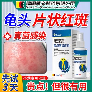 男士龟头红斑红点脱皮痒男性龟头上有起小红点炎真菌感染喷雾剂xj