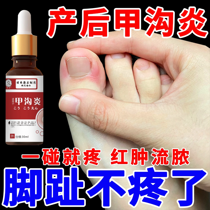 产后甲沟炎治疗脚趾灰指甲息肉去除药脱甲嵌甲发炎红肿软化正品wg