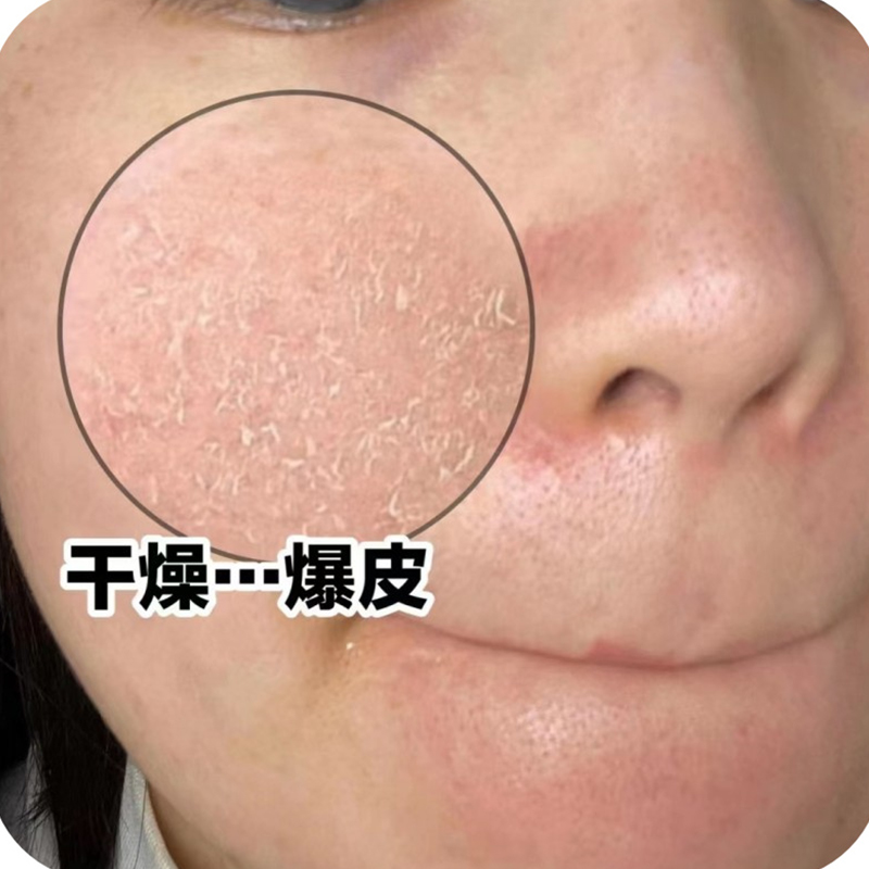 脸上起皮干燥脸干掉皮脸部干皮起皮干痒冬天皮肤干燥脱皮护肤润肤