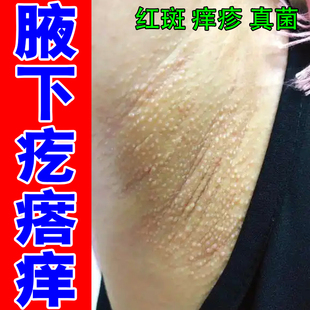 腋下疙瘩痒冶胳肢窝过敏起痘痘粗糙宝宝腋下淹了出汗专用修复