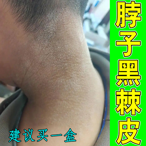 脖子黑棘皮腋下膝关节黑色素沉淀儿童肥胖脖颈后洗不干净修护保湿