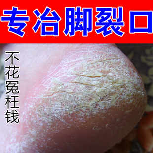 专冶脚裂口脚粗糙严重裂口子手脚蜕皮秋冬天干燥脚角质层增厚去皮