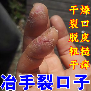 手指头裂口子干裂修复护手霜开裂脱皮裂开手足开口手脚冬季裂膏