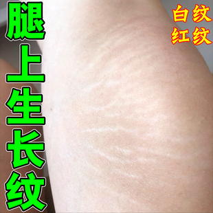 去肥胖纹修复霜生长纹消除学生大腿淡化妊娠纹精油祛紧致肚皮膏