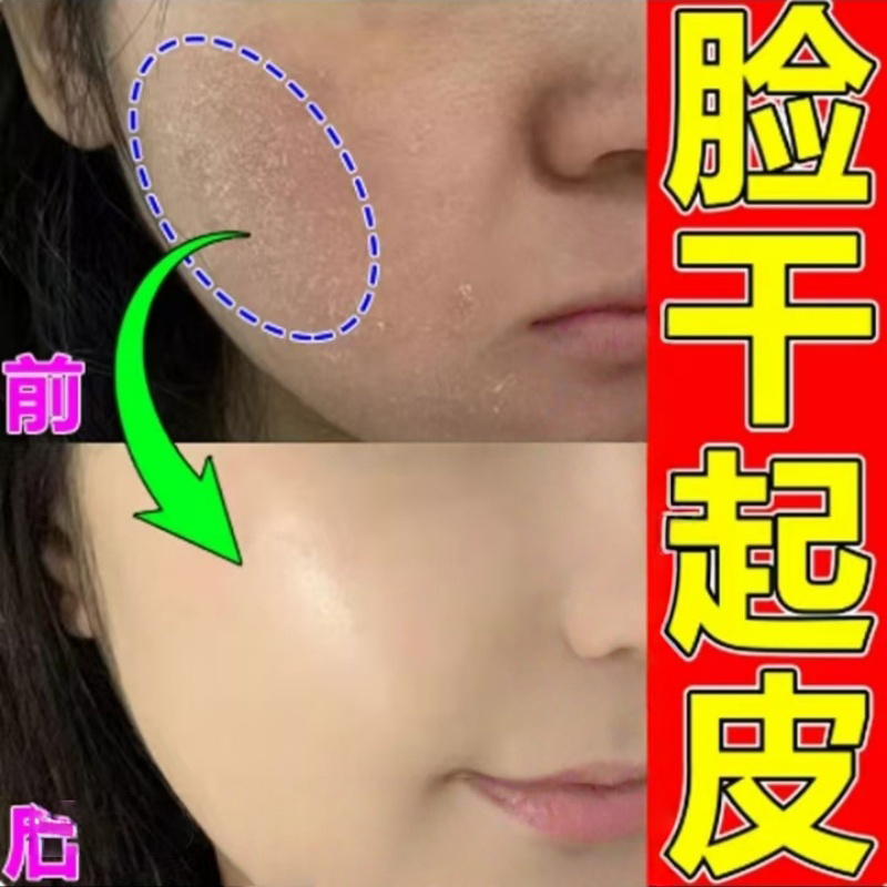 脸上起干皮掉皮干皮脸起皮嘴边干裂起皮皮肤紧绷鼻子两侧发红乳膏