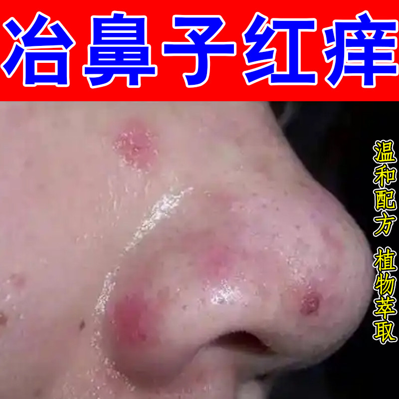 冶鼻子红痒鼻周红肿痘鼻翼两侧起皮肤消毒护理（消）