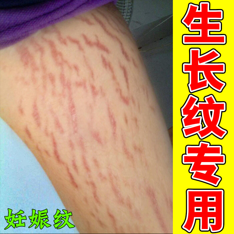 身上长白色红色纹肥胖纹修复药霜