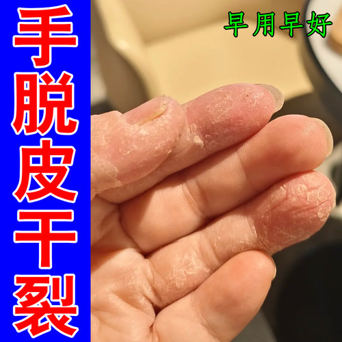 手脱皮干裂感染剥脱性角质松懈症手掌粗糙掉屑变厚干燥修护保湿药