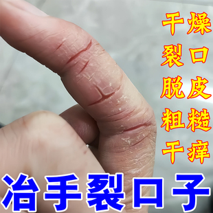 手指头裂口子干裂修复护手霜开裂脱皮裂开手足开口手脚冬季裂膏