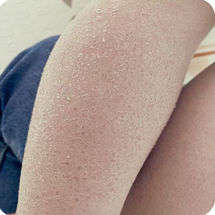 脸上起皮脸干皮脱皮干痒秋冬脸部掉皮发痒皮肤粗糙起干皮