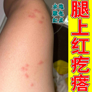 腿上红疙瘩虫咬过敏荨麻长痘痘儿童成人身上皮肤粗糙干燥痒草本