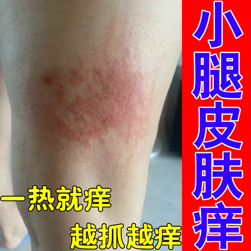 小腿痒皮肤干燥粗糙起红疙瘩痒长红斑红肿刺挠抓挠专用痒草本药乳