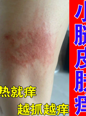 小腿痒皮肤干燥粗糙起红疙瘩痒药